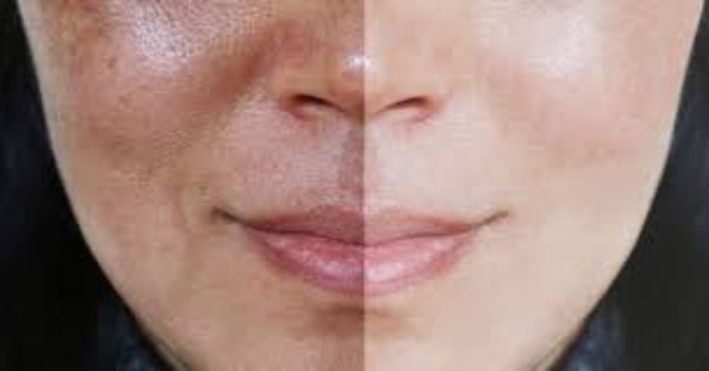 before and after face pigmentation issue