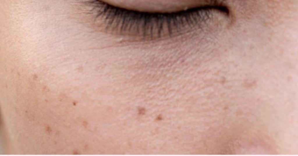 under eye pigmentation